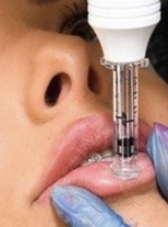 Needle-less Lip Filler Touch Up