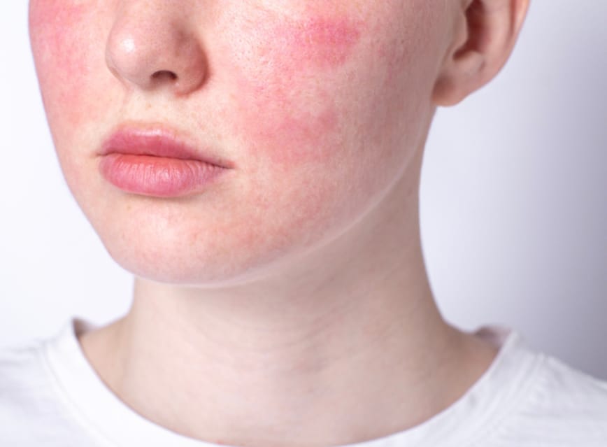 Rosacea And Sensitive Facial