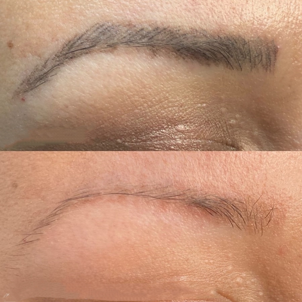 Eyebrow tattoo removal at Anchors Aweigh Spa in Spring, TX