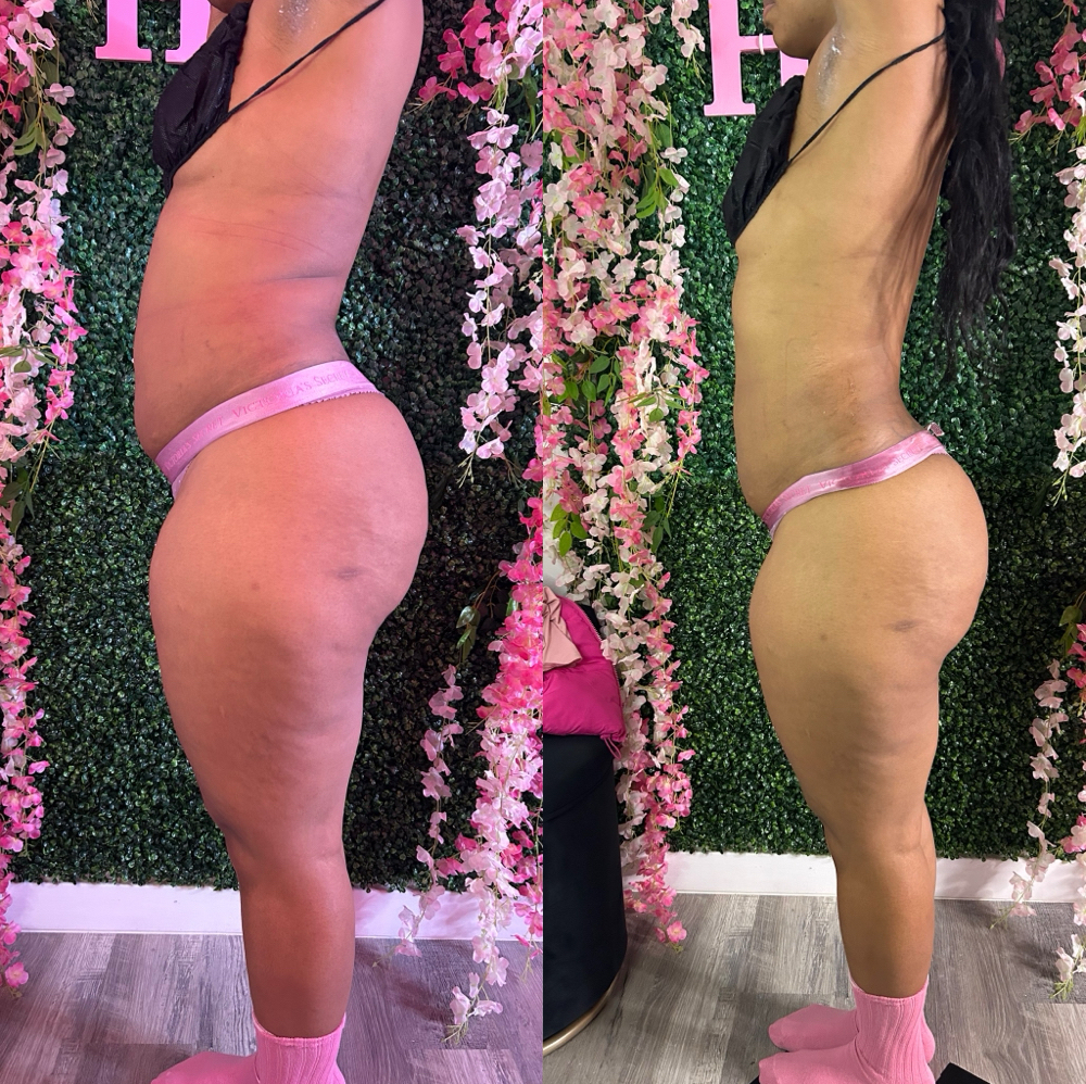 Tax Season Special  1 Hour Fat at HVS BODY in Shaker Hts, OH