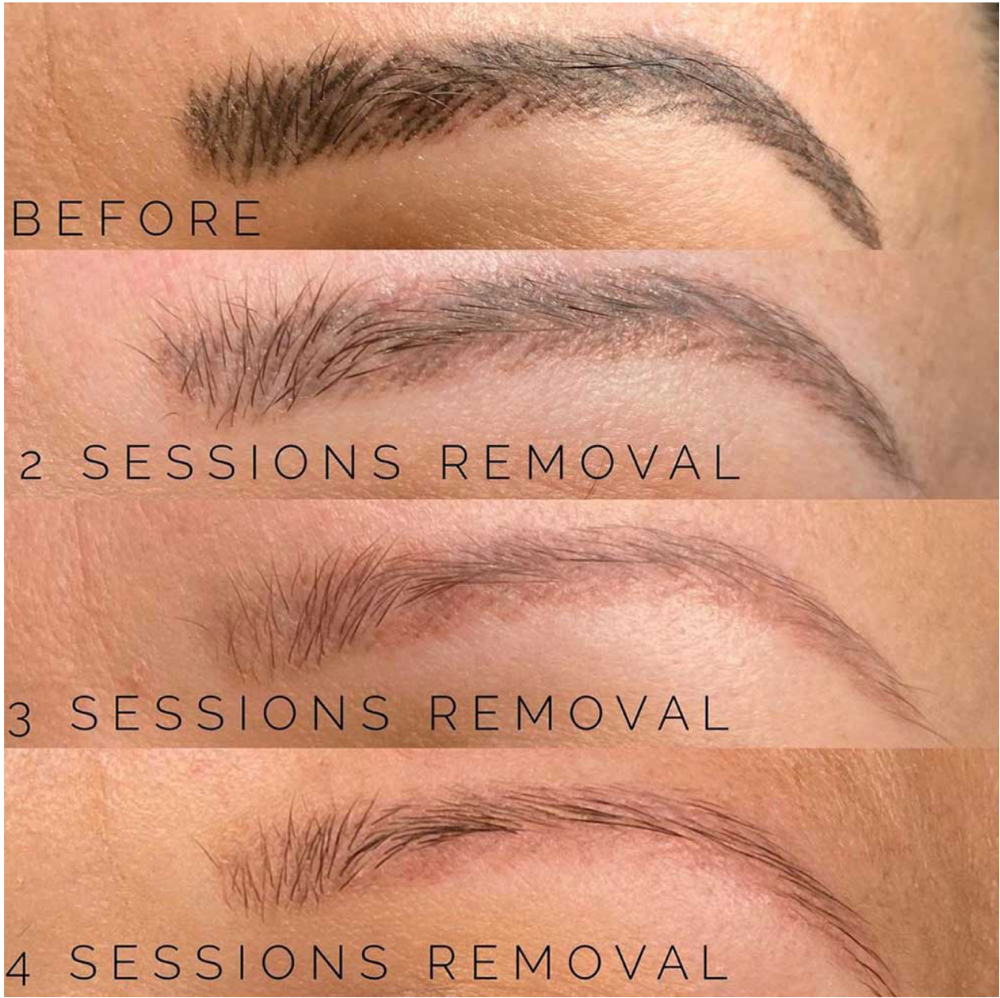 Chemical Tattoo Removal at Faces by DeAngela in New Brockton, AL
