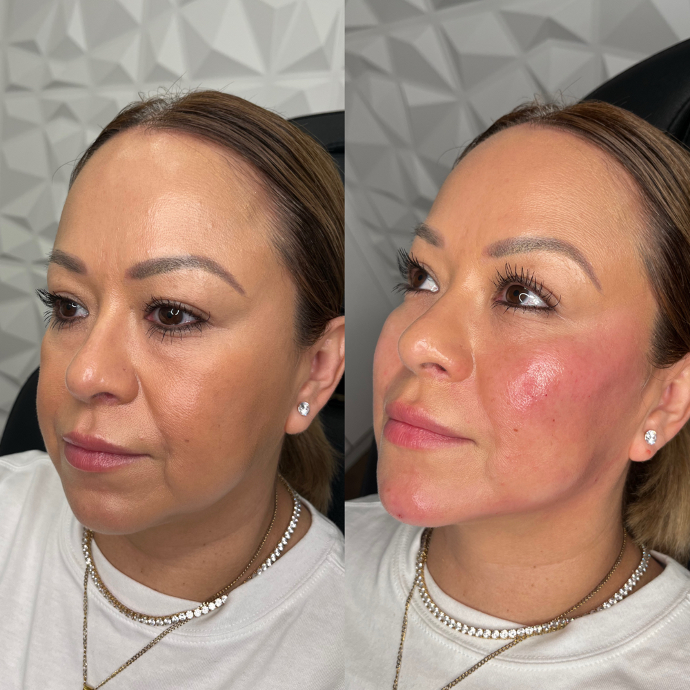 Cheek Filler