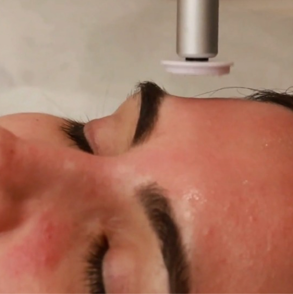 Microneedling With Growth Factors at GlowDerm Clinic in San Jose, CA