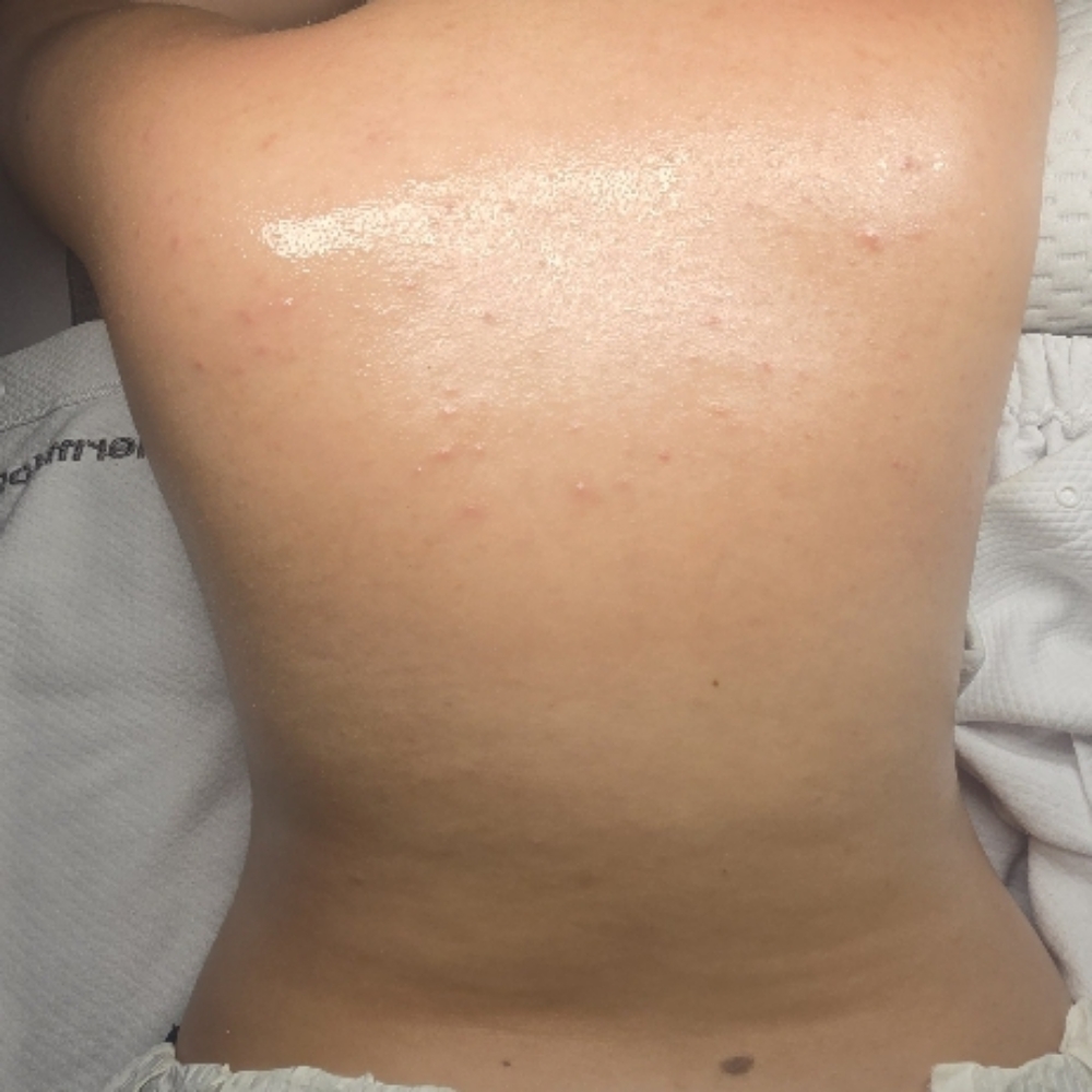 Bacial at CareBeautyDerm in Smithtown, NY