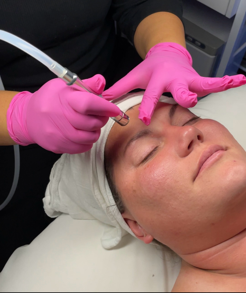 Mircodermabrasion Facial