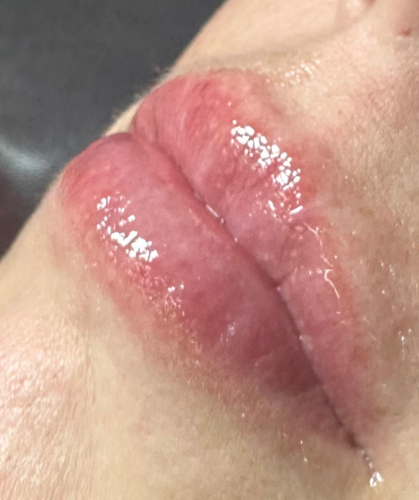 Lip Filler 1.5ML