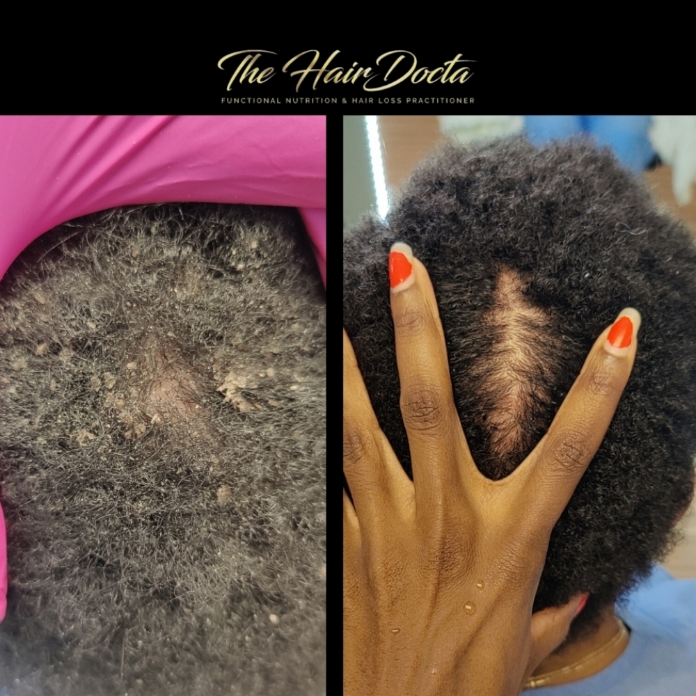 Seborrheic Dermatitis Treatment at The Hairdocta Clinic in Kansas City, MO
