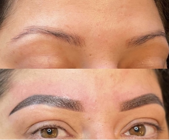 Brow Correction