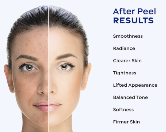 Glycolic Peel Facial