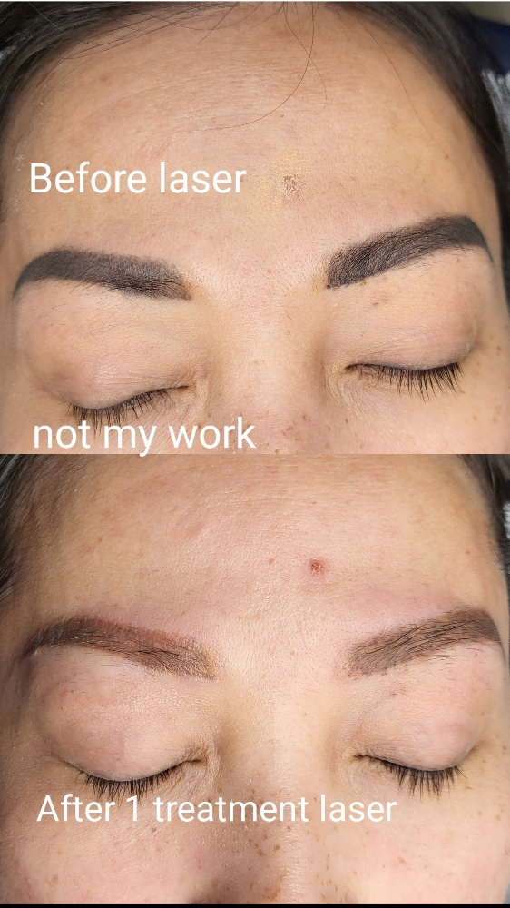 BROW LASER REMOVAL