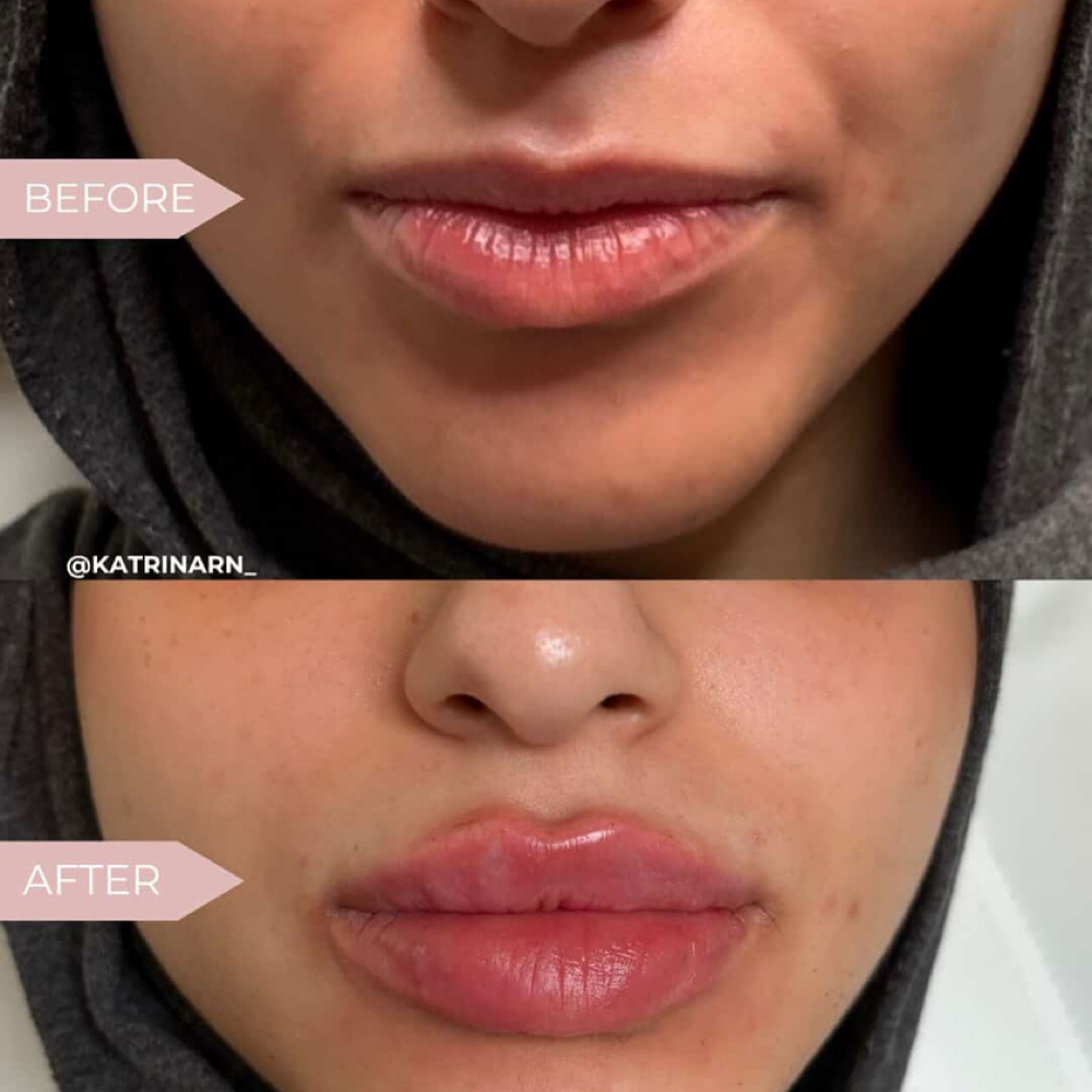 Lip Filler- New Client (June Skin) at Eternal Glow Med Spa in Waddell, AZ