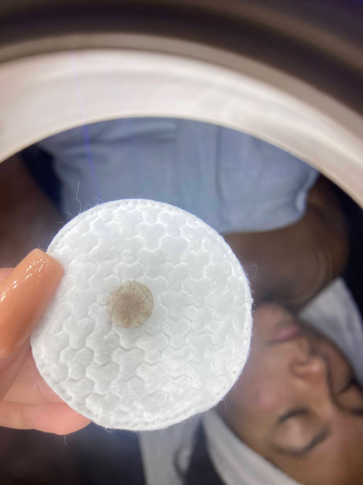 Microdermabrasion
