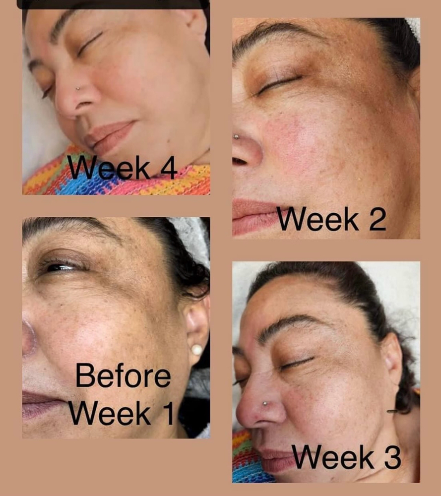 Chemical Peel Facial