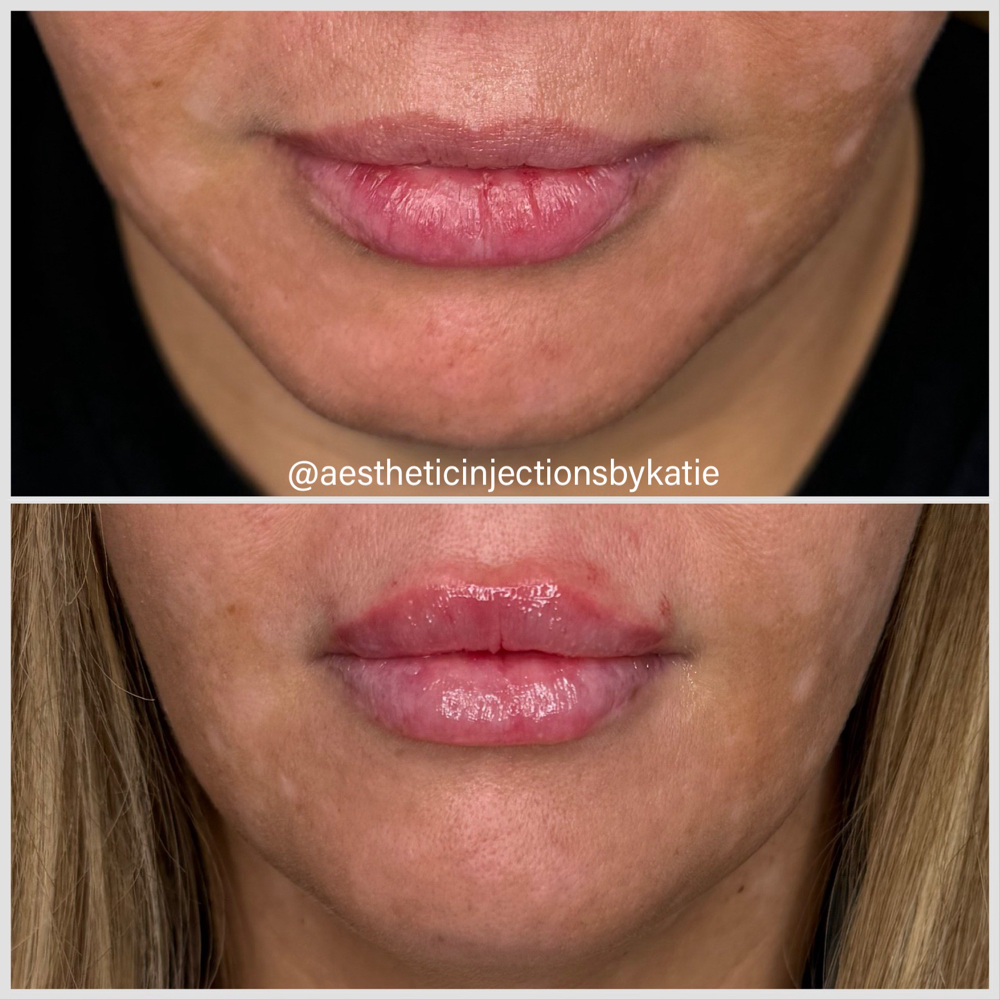 Lip Filler at Aesthetic Injections by Katie in West Plains, MO