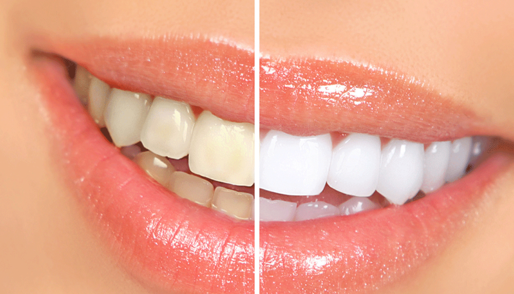 ✨Teeth Whitening FLASH SALE ✨
