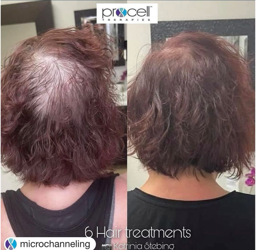 Procell Hair Six Treatments