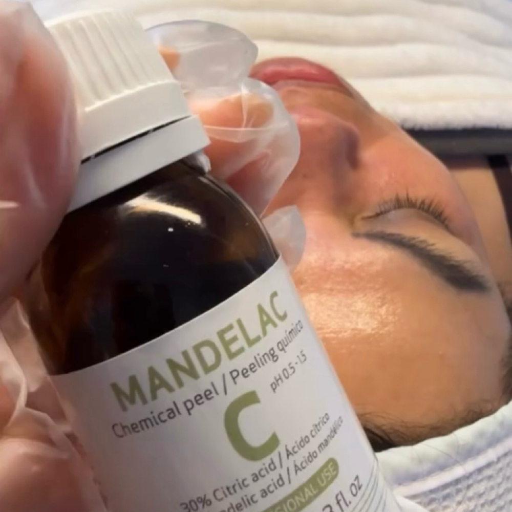Peeling Quimico at Any Beauty Aesthetics Care in New York, NY