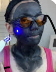 Carbon Laser Peel