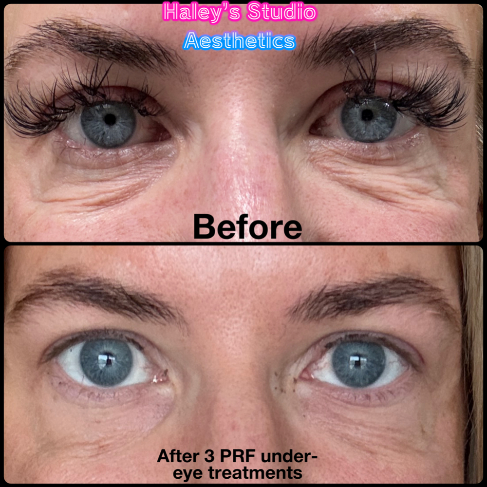 Liquid PRF (Platelet Rich Fibrin)