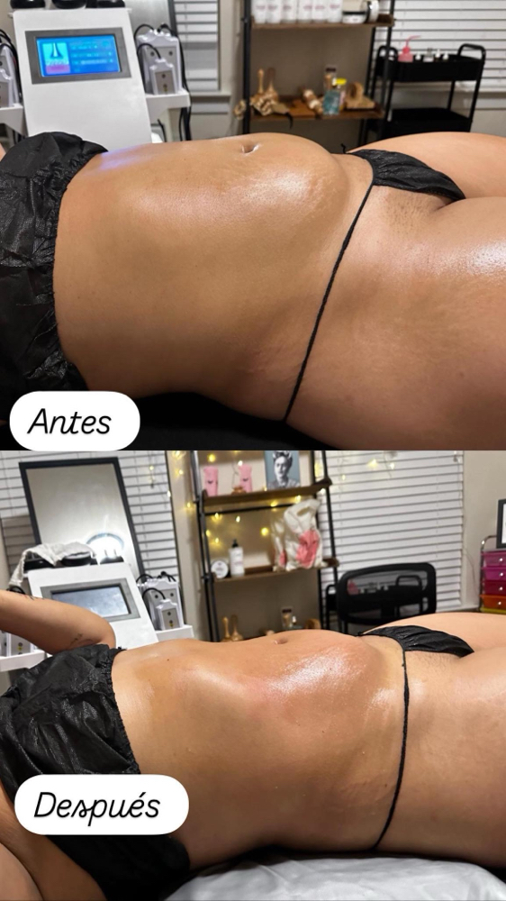 abdomen and back reducing package