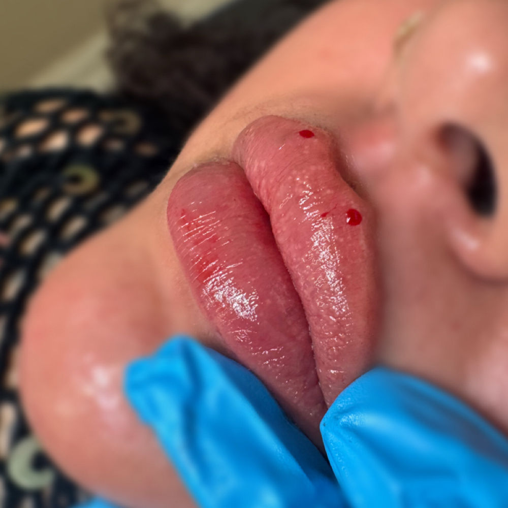 August Lip Filler Special at iLash Studio & Aesthetics in El Campo, TX