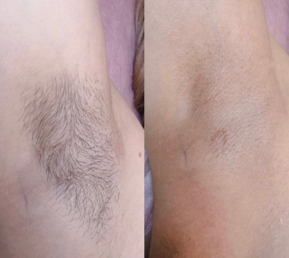Brazilian & Underarms Sugaring
