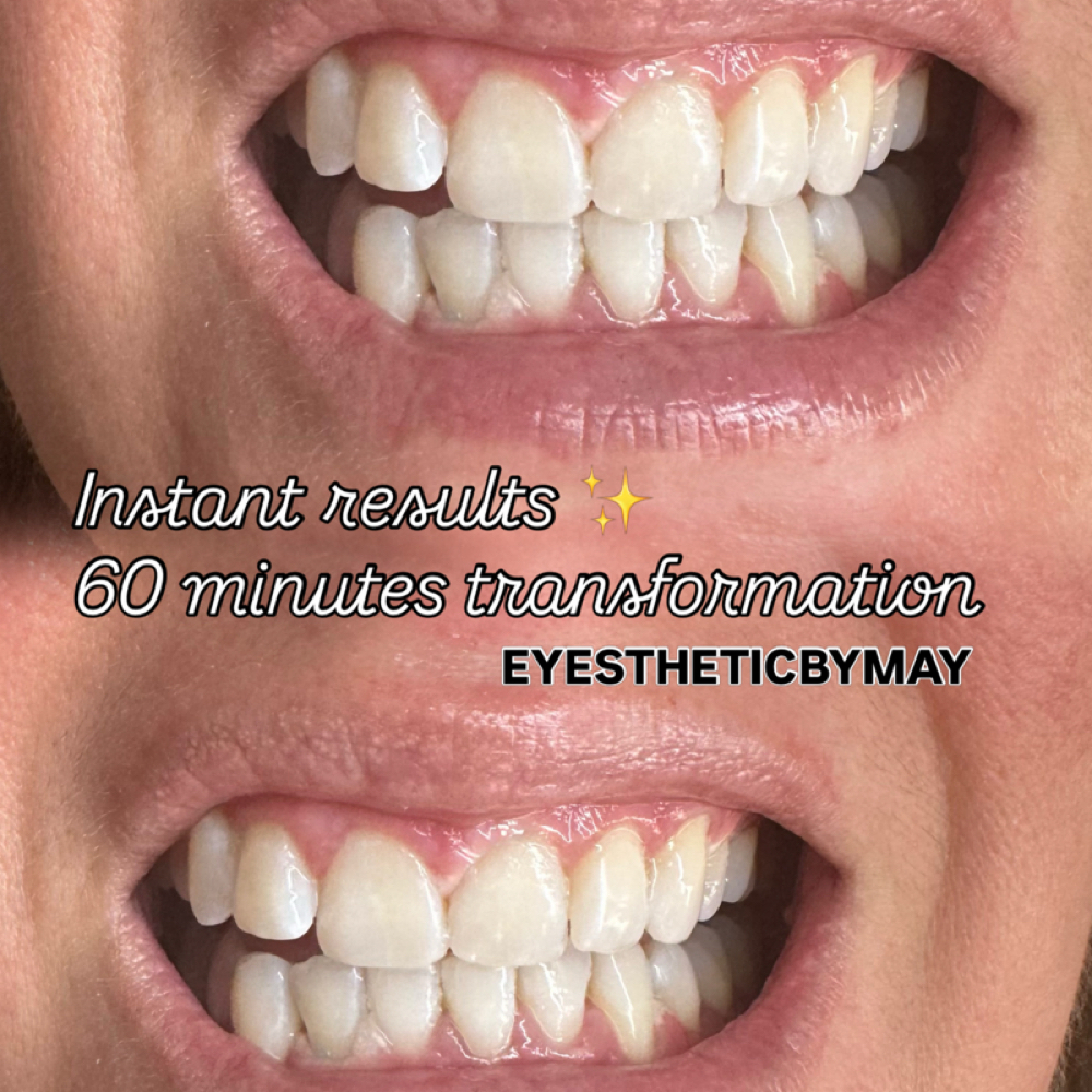 Teeth Whitening at ππ²ππ¬ππ‘πππ’π ππ² πππ² in Lexington, KY