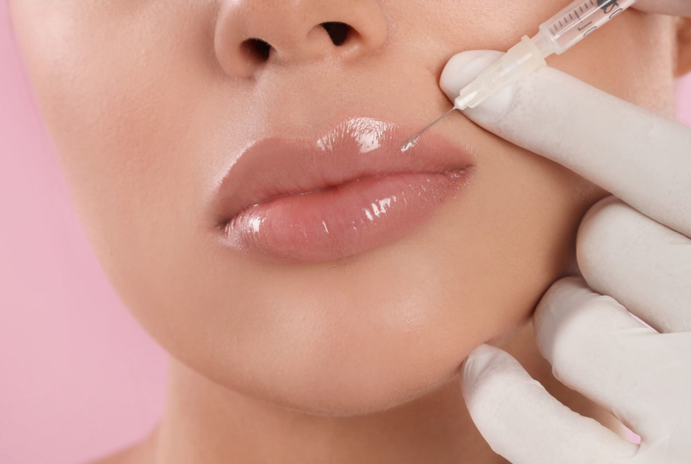 Lip Filler
