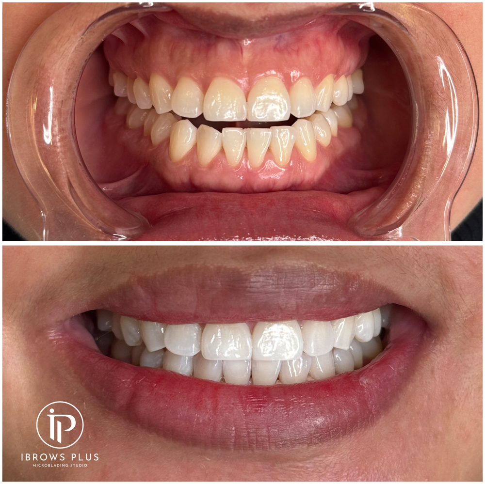 Teeth Whitening
