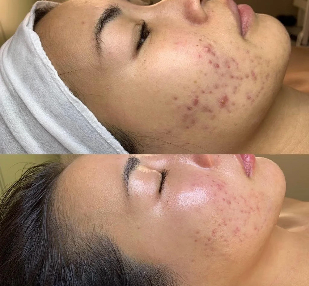Acne Facial