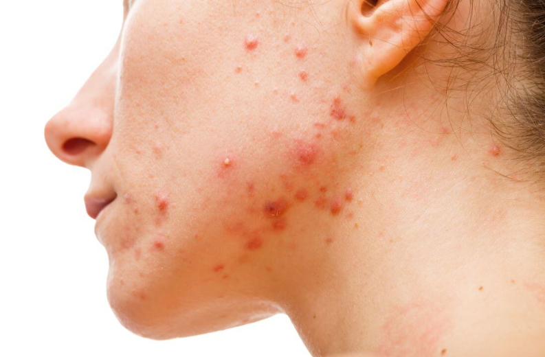 Acne-Prone Skin Facial