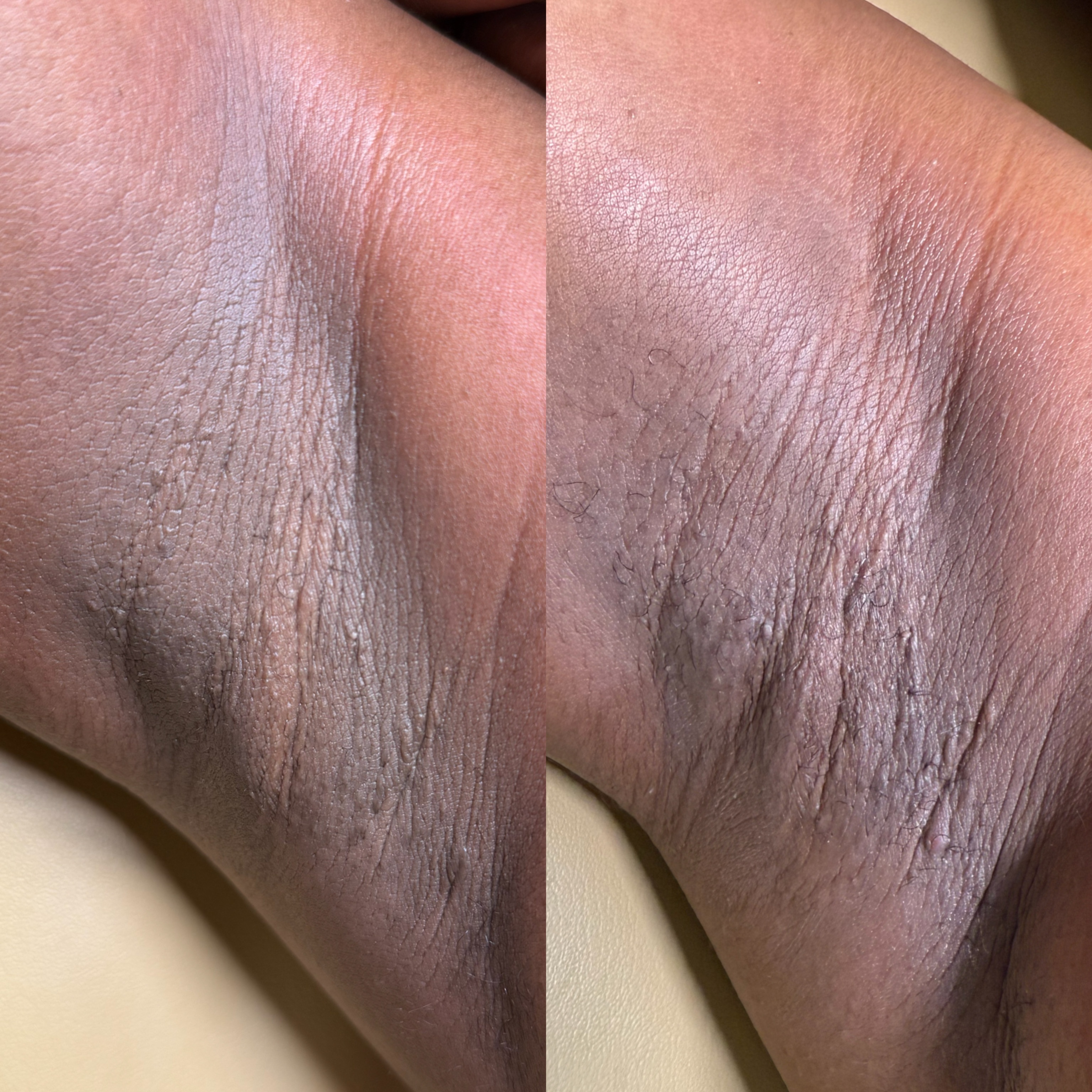 Intimate Bleaching(Single Sessions)