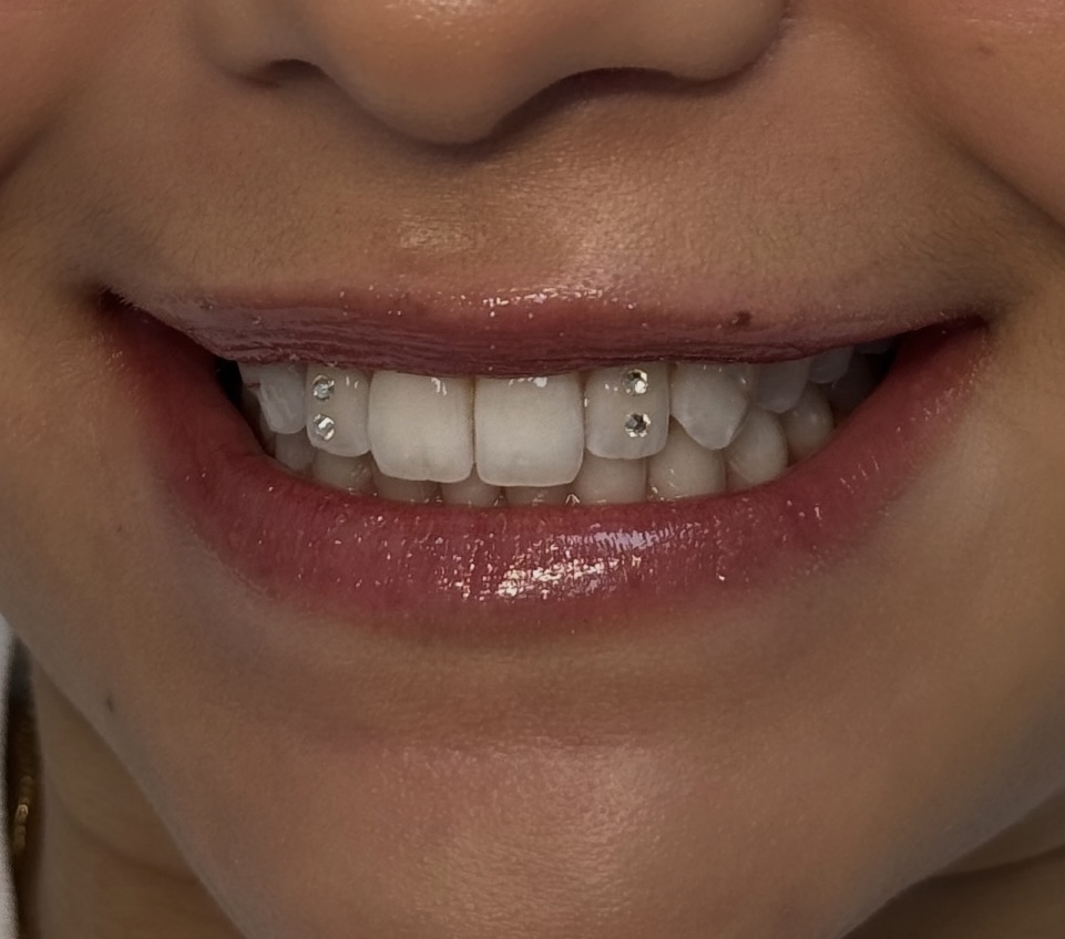 4 Tooth Gems