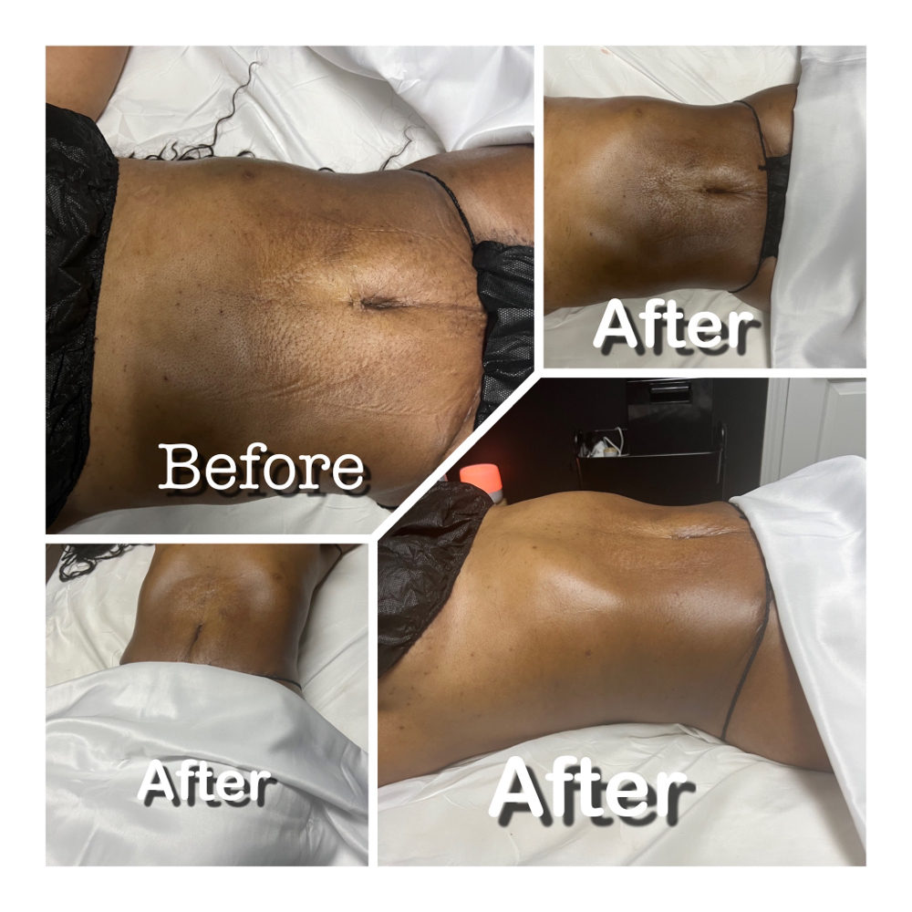 10 MLD/ 10Red/6 cav/1 at Wholistic Recovery & Wellness Spa in Snellville, GA