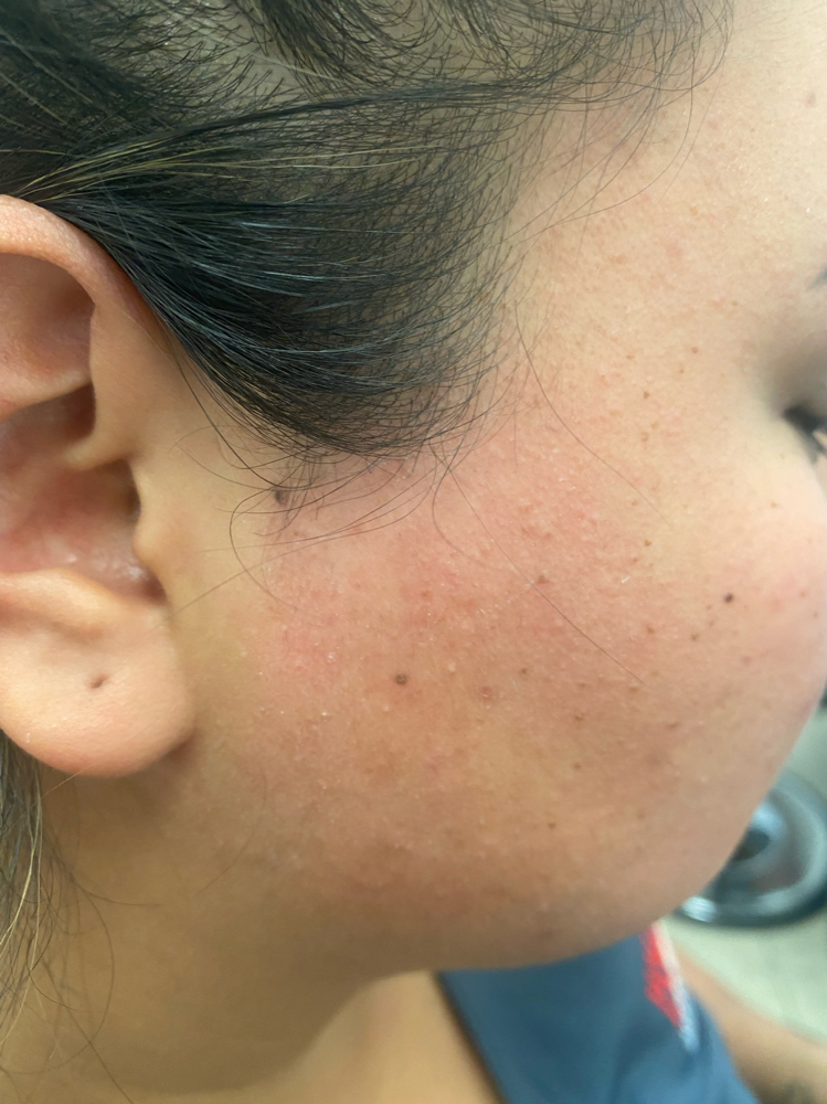 Sideburns/ cheek Hair Removal