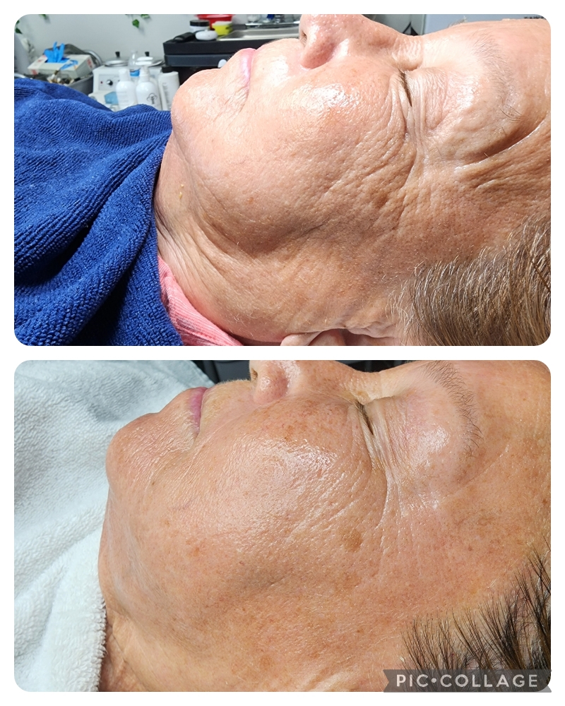 Radio Frequency Skin Tightening