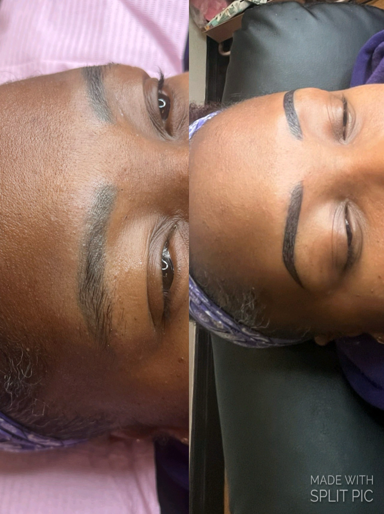 Brow Correction