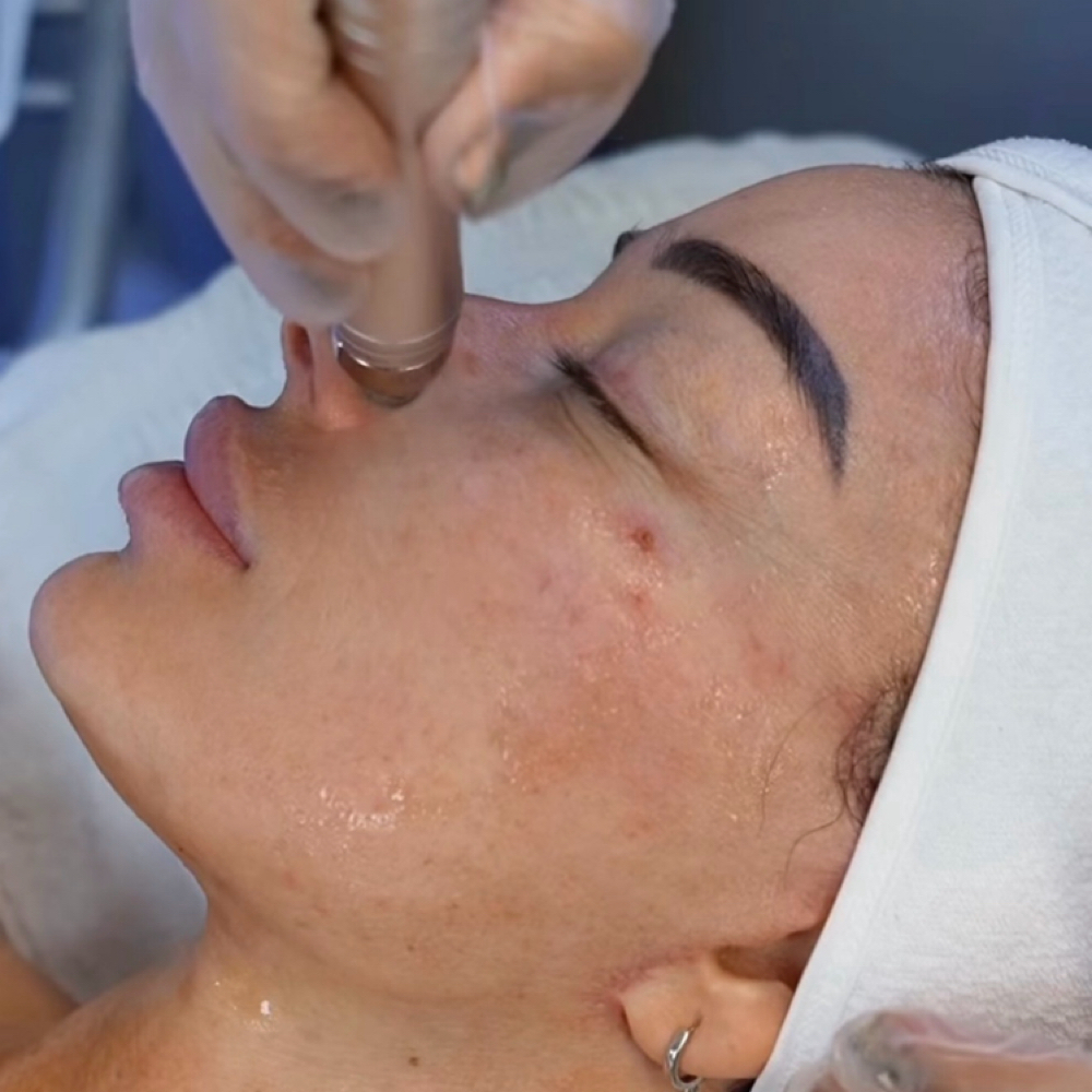 HydroDiamond Facial at Fountain of Youth Spa in Yuma, AZ