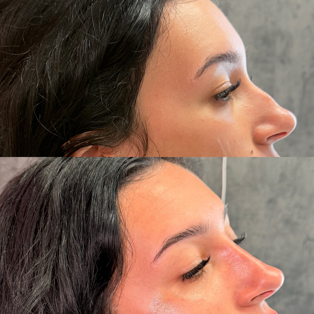 Liquid Rhinoplasty - Nose Filler