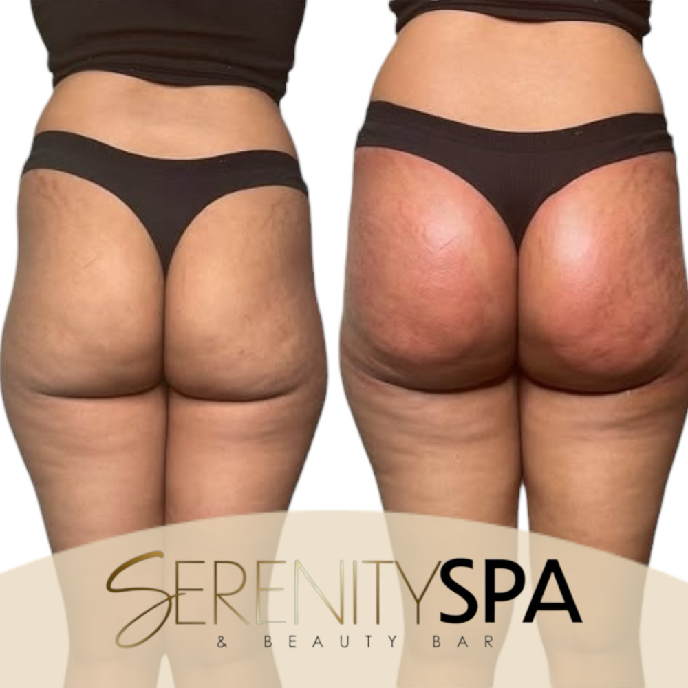 Intense BBL OR Hip Combo at Serenity Spa & Beauty Bar in Warwick, RI