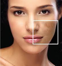 Customized Facial:Hyperpigmentation