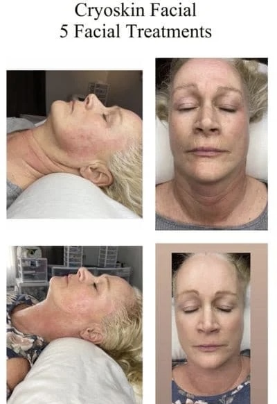Body- Neveskin Facial 5 Pack