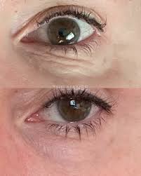 Under Eye Wrinkles