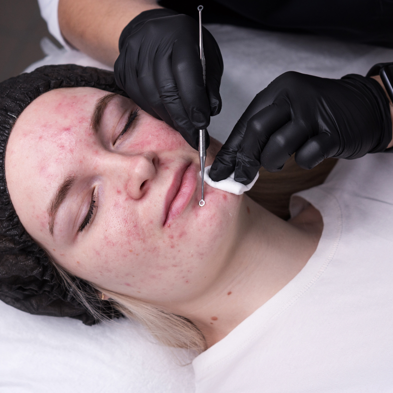 Acne Treatment