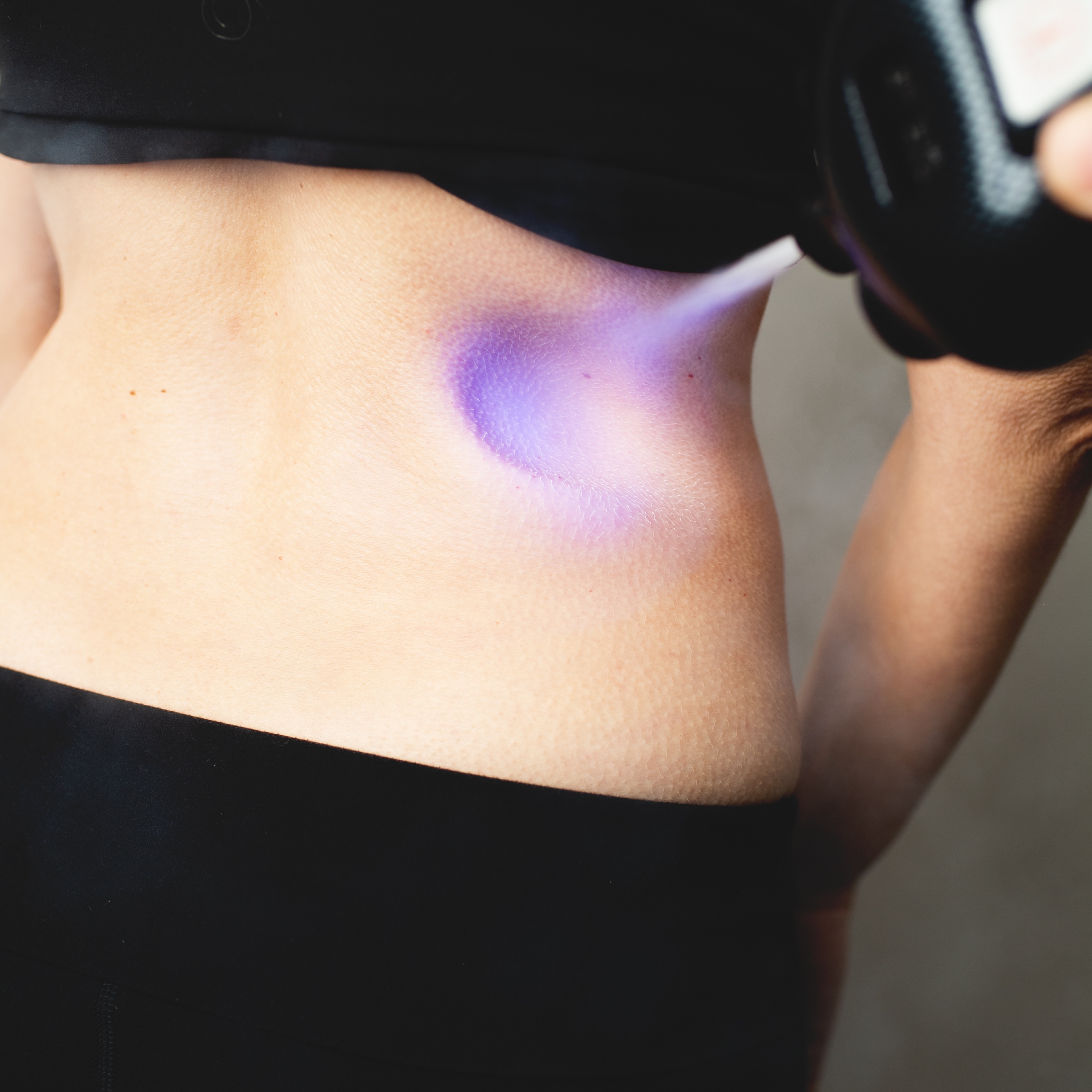 Back Sculpt Cryotherapy