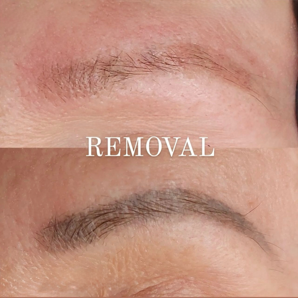 Tattoo Removal at Lexbrows Studio in Draper, UT