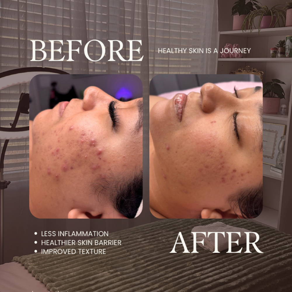 Clear with Luv at Luv U Aesthetics in Goodyear, AZ