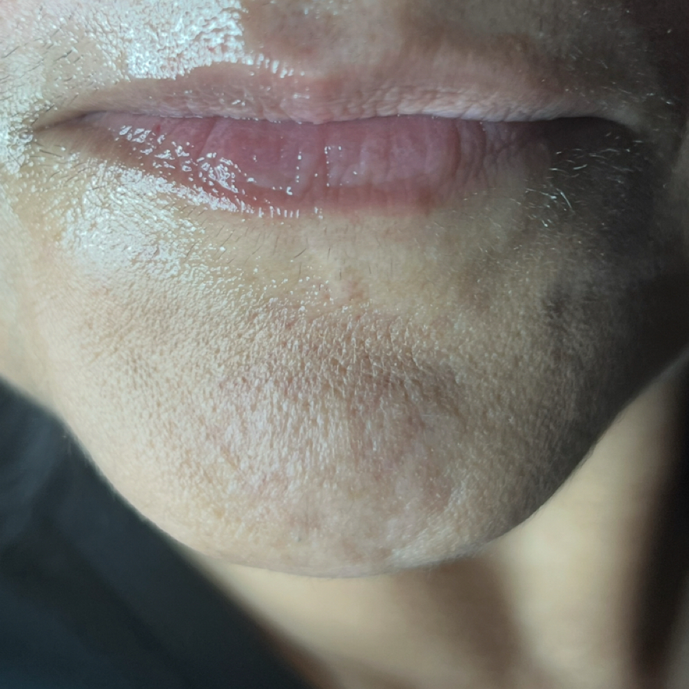 Chin Filler at Pure Bliss Studios in Fort worth, TX