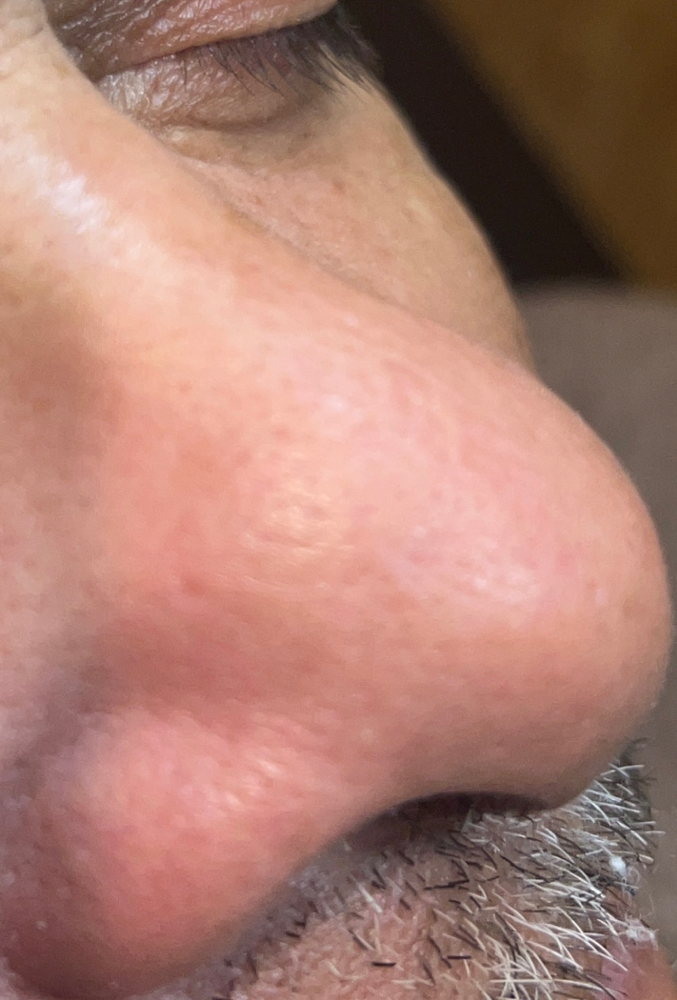 Nose Comedone Removal
