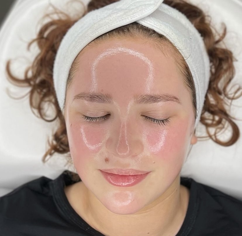 Chemical Peel